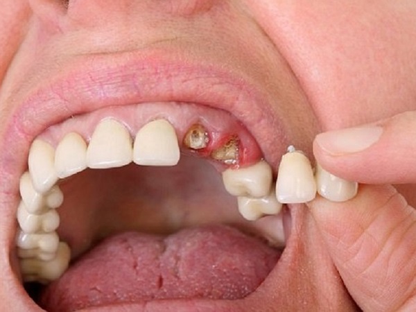 Nằm mơ thấy mình bị gãy răng báo mộng điềm hên hay xui?