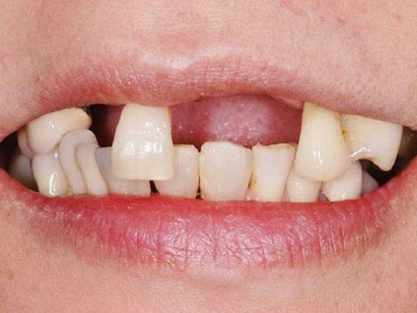 Nằm mơ thấy mình bị gãy răng báo mộng điềm hên hay xui?